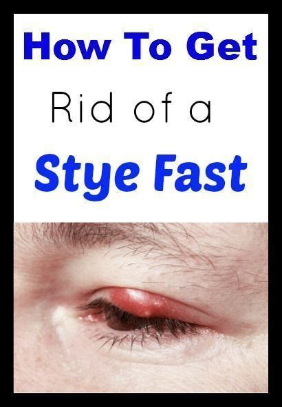 How To Treat A Stye In The Eye Under Eyelid Avoid Popping Stye Eyestyehowtoremove Eyestyeho