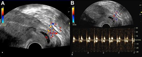 Suggested Method For The Management Of Heterotopic Cervical Pregnancy