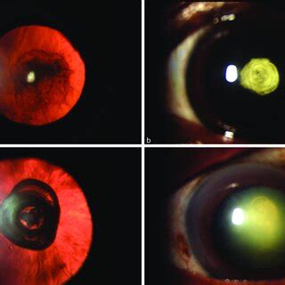 Anterior Segment Slit Lamp Photography Showing Type 1 A Type 2 B