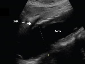 Discovering The Aorta Through Ultrasound Critical Care Sonography