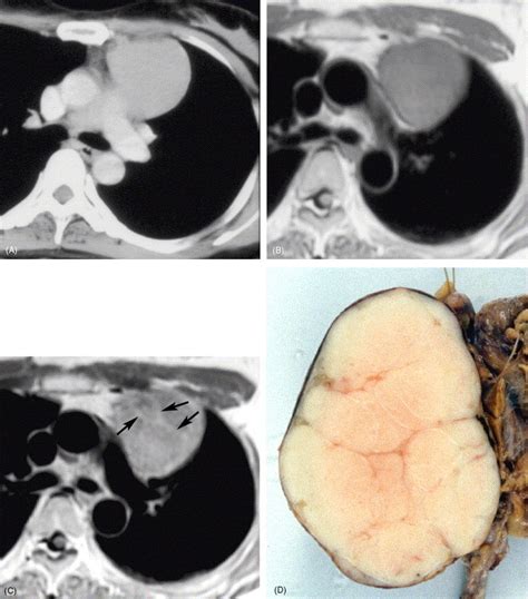 thymic epithelial tumors comparison  ct   imaging findings