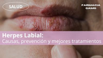 Herpes Labial Causas Prevenci N Y Mejores Tratamientos