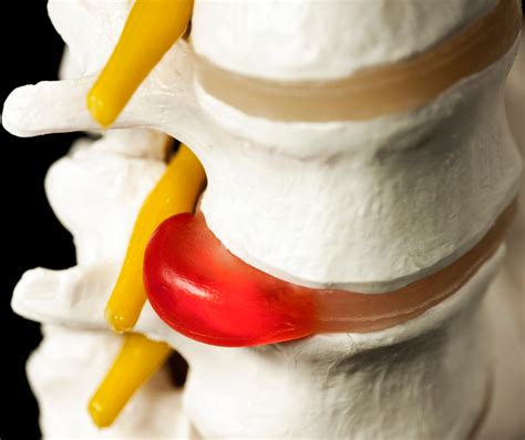 Understanding Herniated Disc!