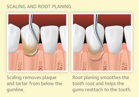 Scaling And Root Planing Infinity Dental Associates