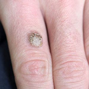 Planters Wart On Hand Removal | Bruin Blog