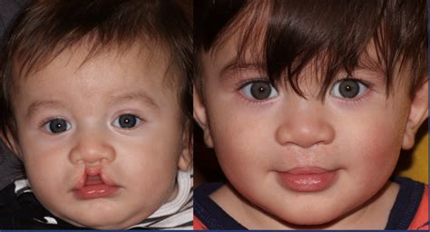 Bilateral Cleft Lip And Palate Before And After