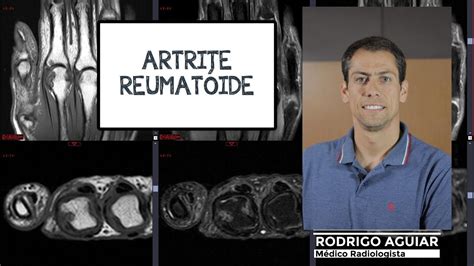 Artrite Reumatóide Achados Radiográficos YouTube