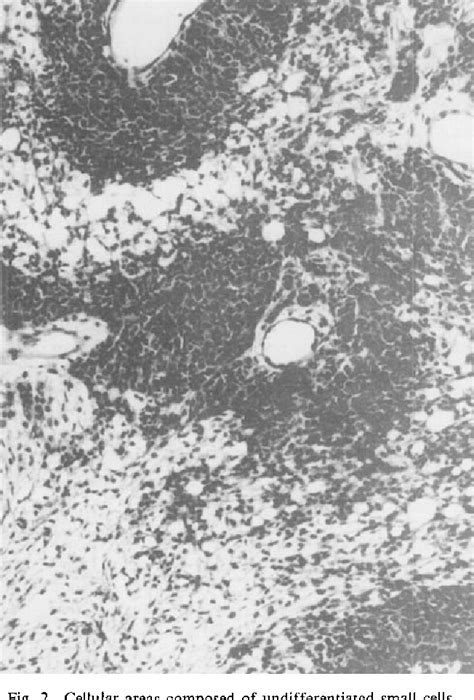 Figure 3 From IntraAbdominal Desmoplastic Small Round Cell Tumor