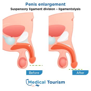 Collection 99 Pictures Penis Enlargement Surgery Before And After