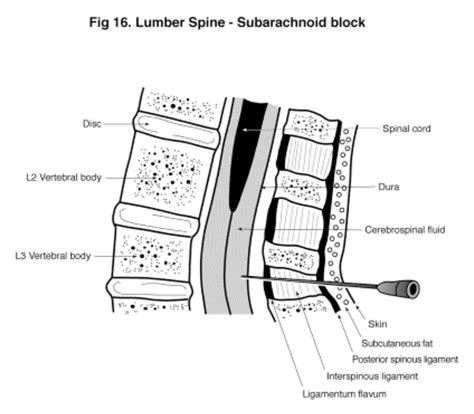 Spinal Block