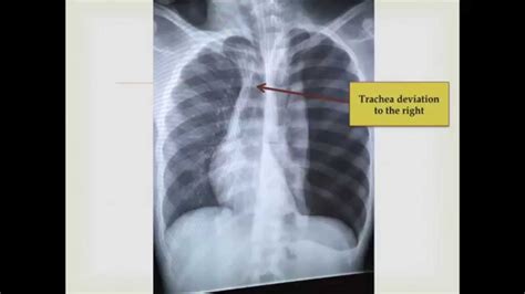 Tracheal Deviation Tension Pneumothorax