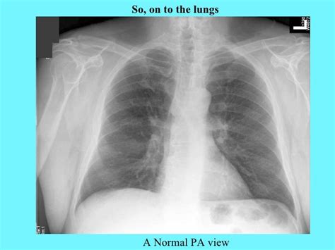 Bacterial pneumonia chest x ray findings - Flexartists