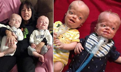 Pfeiffer Syndrome Treatment