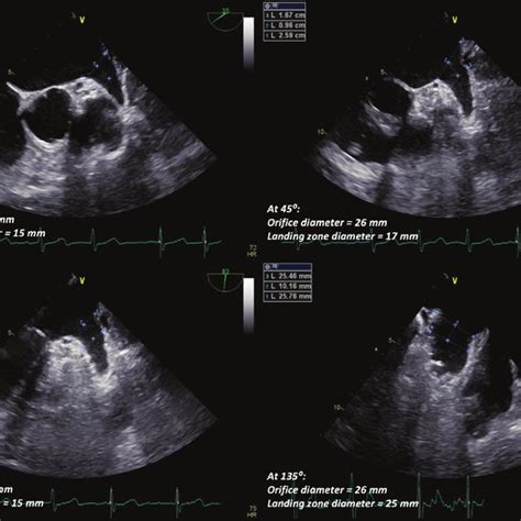 Intracardiac Echocardiography ICE Guidance For Left Atrial Appendage