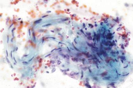 Respiratory Cytopathology Flashcards Quizlet