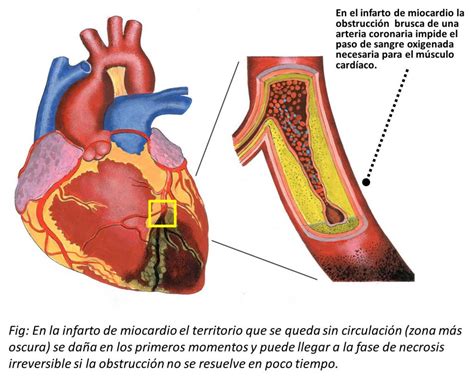 El infarto agudo de miocardio una advertencia mortal para el corazón