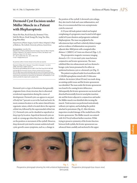 Pdf Dermoid Cyst Excision Under Müller Muscle In A Patient With