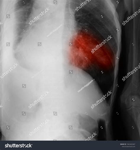 Blurred Pulmonary Tuberculosis Tb Chest Xray Stock Photo Edit Now