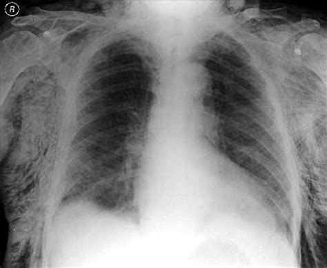 NURSEupdate: X-RAY SHOWING SURGICAL EMPHYSEMA