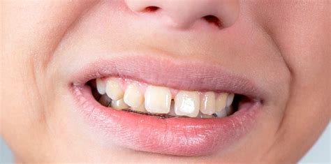 Overbite Stages Symptoms Causes Treatment And More Healthnormal