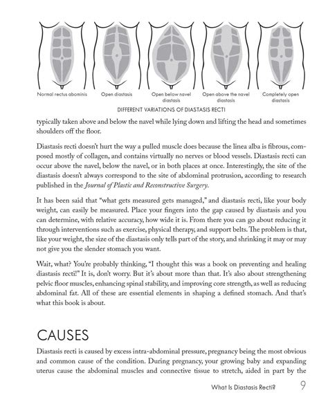 diastasis recti causes - prenatal vitamins