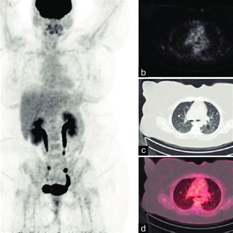 A 42 Year Old Asymptomatic Female With Numerous Solid Pulmonary Download Scientific Diagram