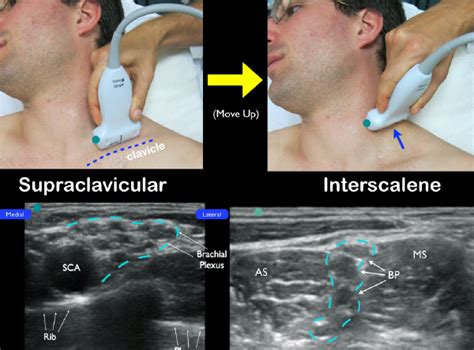 perform ultrasound guided interscalene nerve blocks page