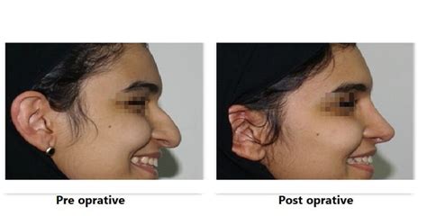 The Dorsal Hump Rhinoplasty Archive