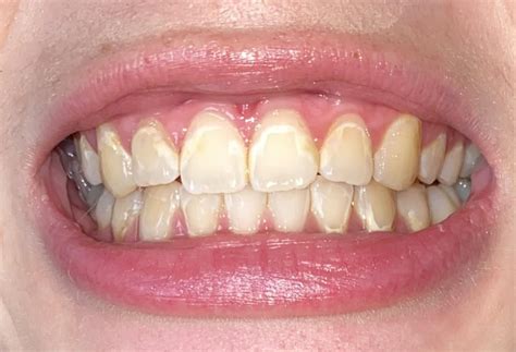 Decalcification Marks From Braces What Can I Do R Askdentists