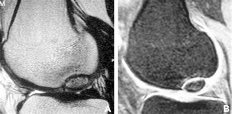 Medial Femoral Condyle Lesion