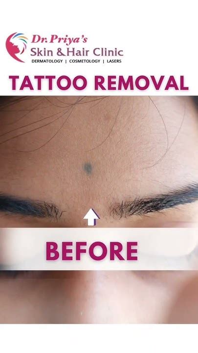 Amazing Tattoo Removal Youtube