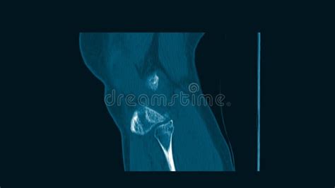 CT Knee Fracture of Intercondylar Eminence of Tibia Stock Footage - Video of hurt, fractured ...