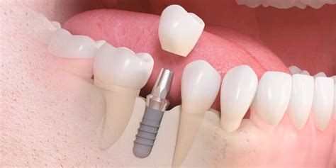 Los Puentes Dentales La Alternativa De Los Implantes Cl Nica Dental