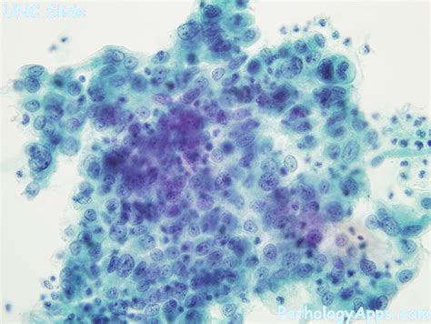 hsil cytology