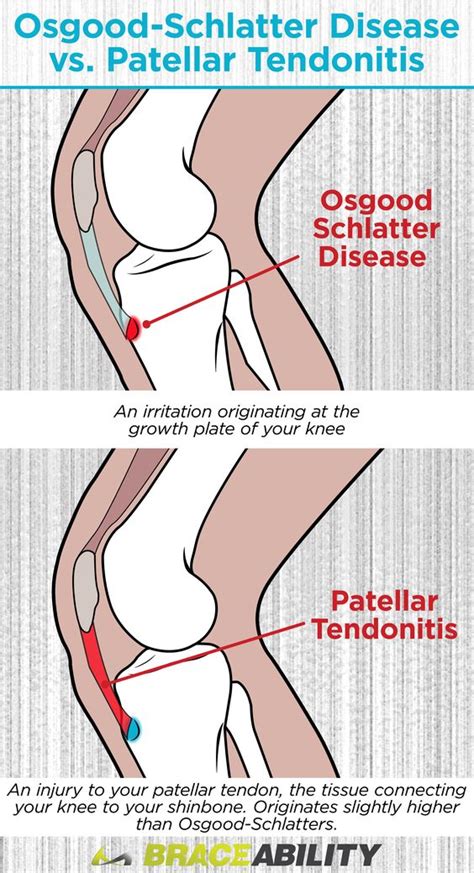 Patellar Tendon Straps Patella Tendonitis Knee Braces And Bands