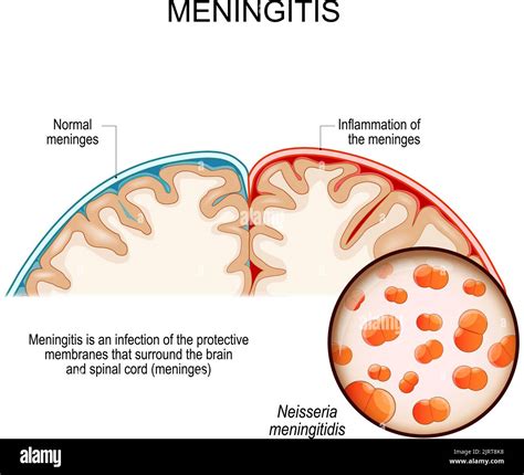 Meningitis Is An Infection Of The Protective Membranes That Surround The Brain And Spinal Cord