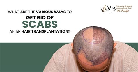 How To Clear The Scabs After Transplanting Hair