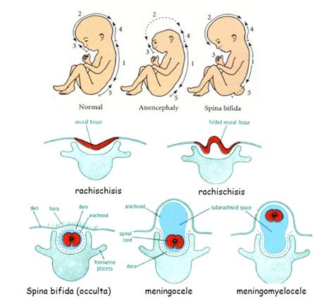 Neural Tube Defects