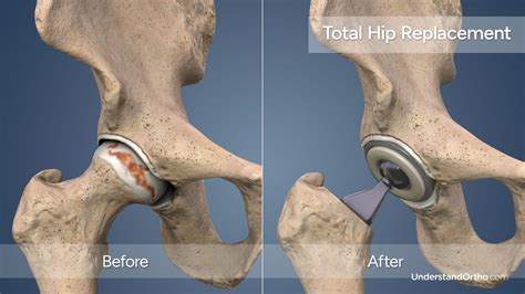 Total Hip Replacement Understandortho