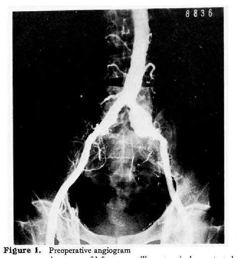 Figure 1 From Title Ascending Aorta Bilateral Femoral Arteries Bypass Viapreperitoneal Route Of