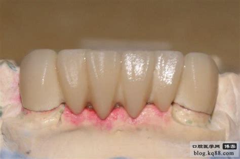 二例前牙烤瓷修复体 鼎易技工室 张鼎易的博客 Kq88口腔博客