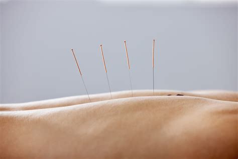Is pain needling at you? Dry needling explained! - Heale's Clinics