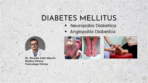 Diabetes Mellitus Complicaciones De Neuropatia Diabetica Angiopatia