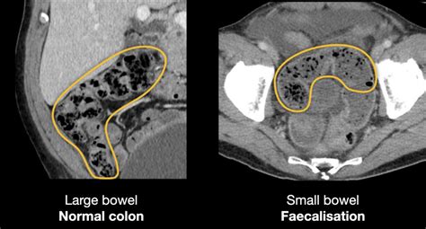 Abdominal CT Small Bowel Obstruction LITFL Radiology Library