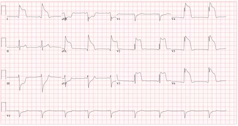 Angina Pectoris, Variant; Prinzmetal Angina