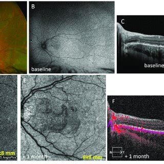 Case Apmppe A Wide Field Fundus Photo Of The Left Eye Showing