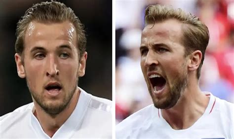 Harry Kane Hair Transplant Everything You Need To Know