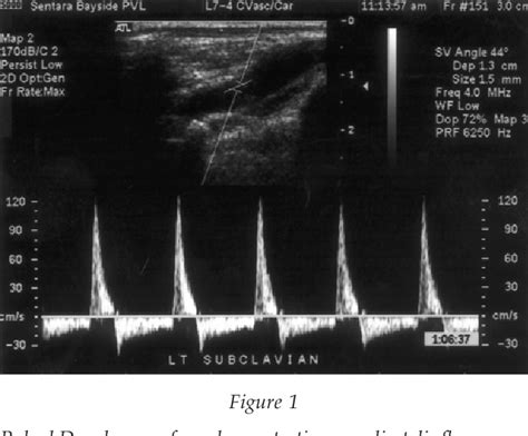 Figure 1 From Pan Diastolic Flow Reversal In The Subclavian Artery An