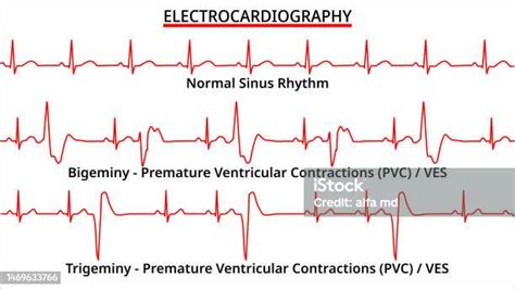 Set Of Ecg Common Abnormalities Bigeminy Vs Trigeminy Premature