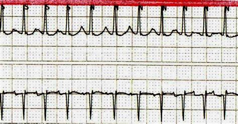 Ecg Channel Atrial Tachycardia